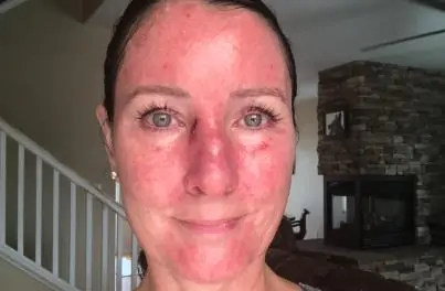 Is It Safe To Tan Using Foil To Reflect Sun